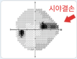 시야검사2